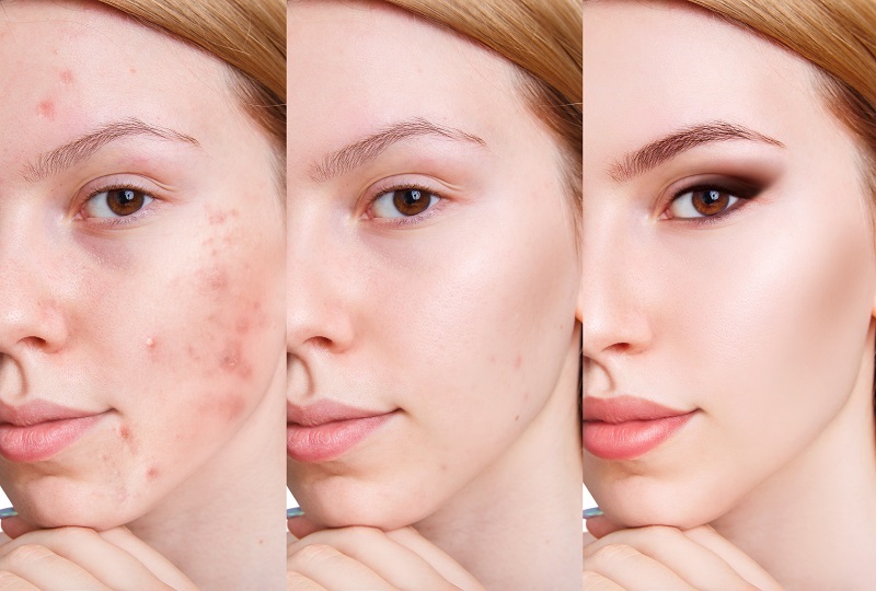 Cách Skincare sau khi nặn mụn?