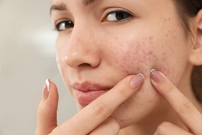 Sử dụng Klenzit MS bị rát da và kích ứng có tiếp tục sử dụng không?