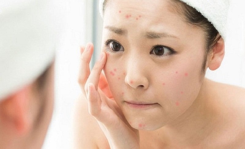 Hướng dẫn cách chăm sóc da mặt sau khi nặn mụn