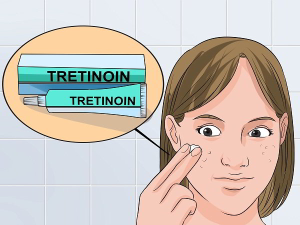 Cách sử dụng Tretinoin trị mụn ẩn hiệu quả