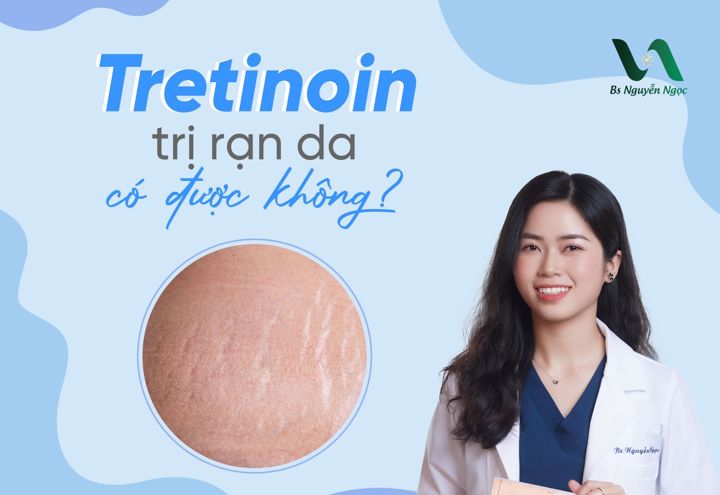 Tretinoin trị rạn da có được không?